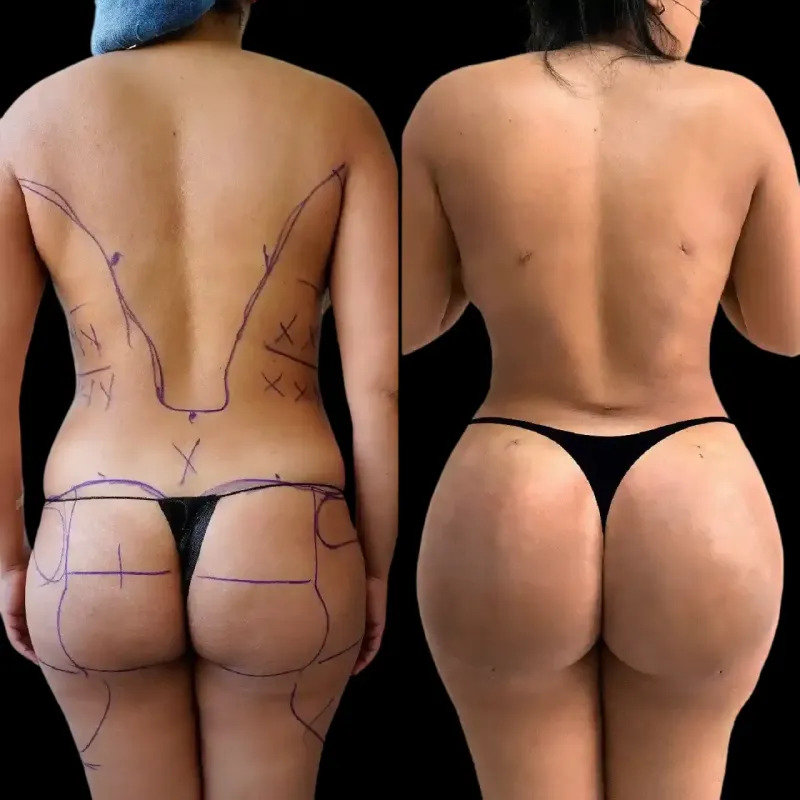 Safety Considerations in Buttock Augmentation