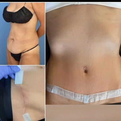 Why Dubai Is a Leading Destination for Mini Tummy Tuck Surgery - THE INFLUENCERZ