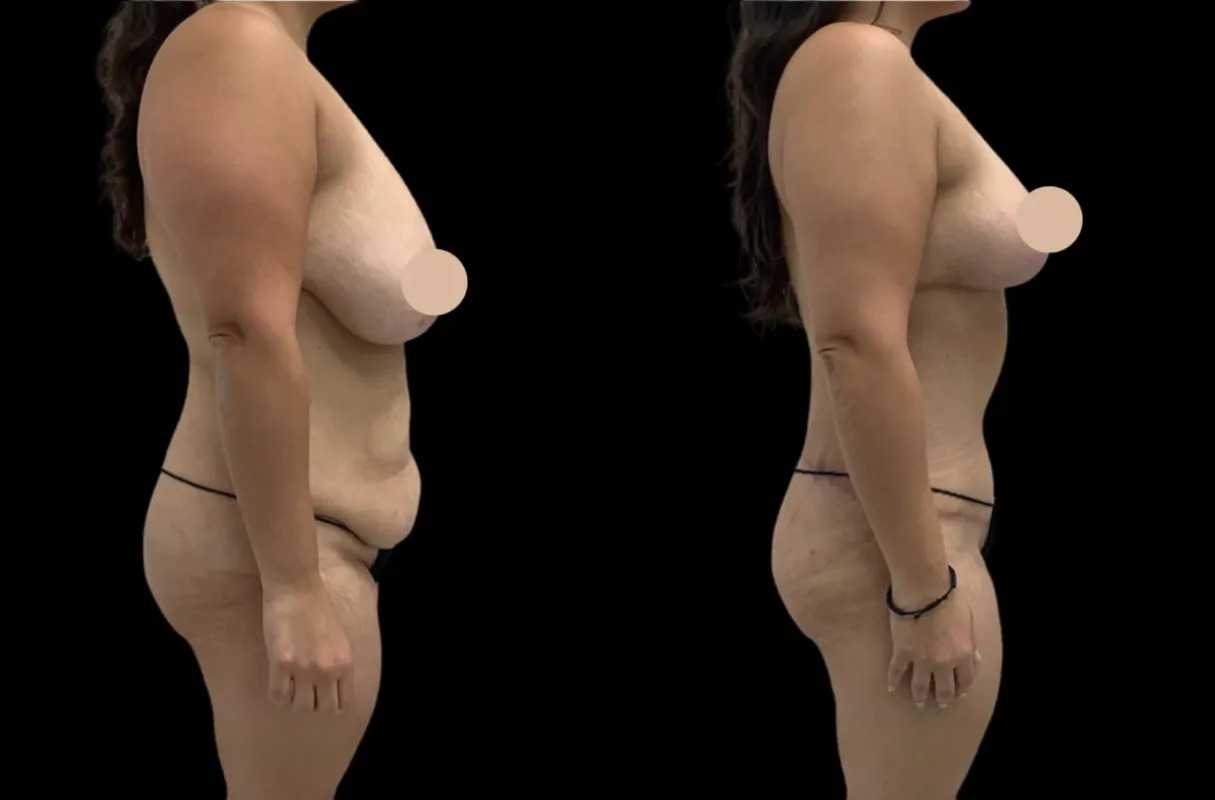 Innovative Techniques in 360 Body Contouring - World News Fox