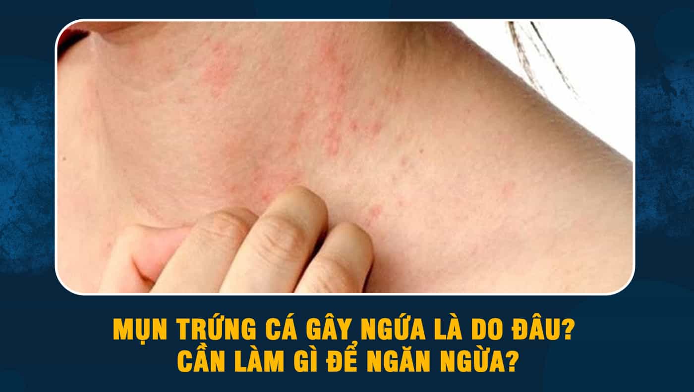 Mụn trứng cá gây ngứa là do đâu? Cần làm gì để ngăn ngừa?