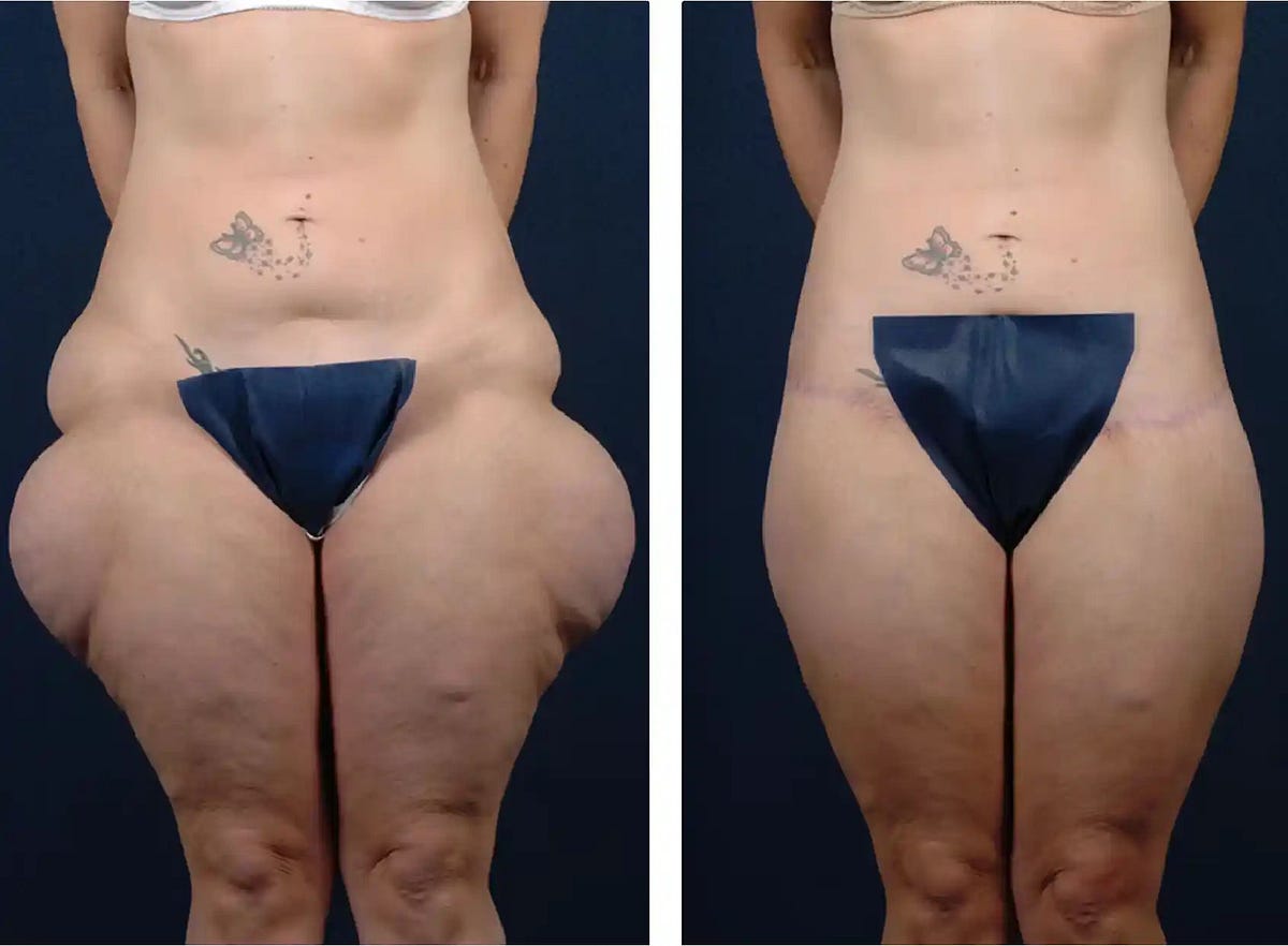 How to Maintain Thigh Lift Surgery Results in Dubai | by Perfect Doctors Clinic | Apr, 2024 | Medium