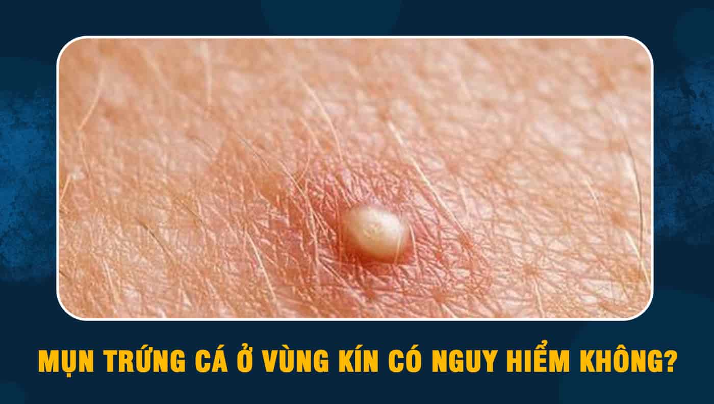 Mụn trứng cá ở vùng kín có thực sự nguy hiểm không?