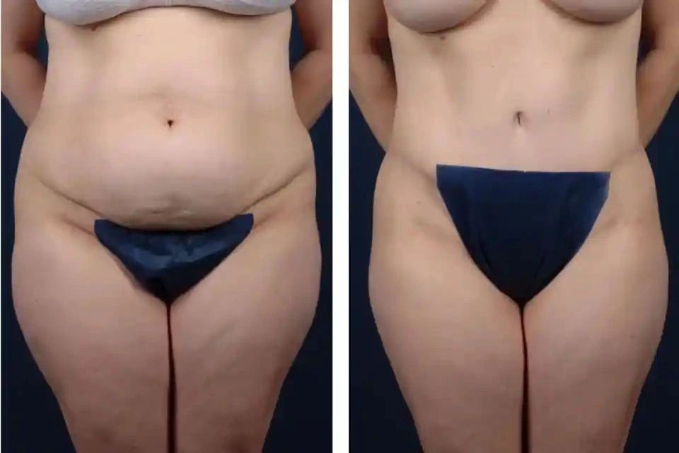 Recovery Tips for Mini Tummy Tuck Patients