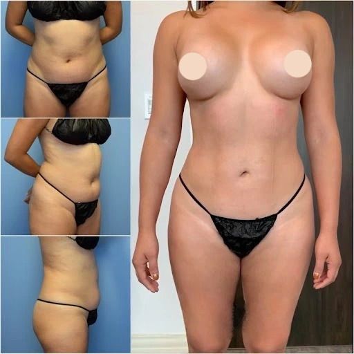 How to Choose the Best Type of Vaser Liposuction in Dubai