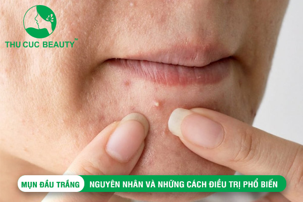 Mụn đầu trắng: Nguyên nhân và cách điều trị phổ biến