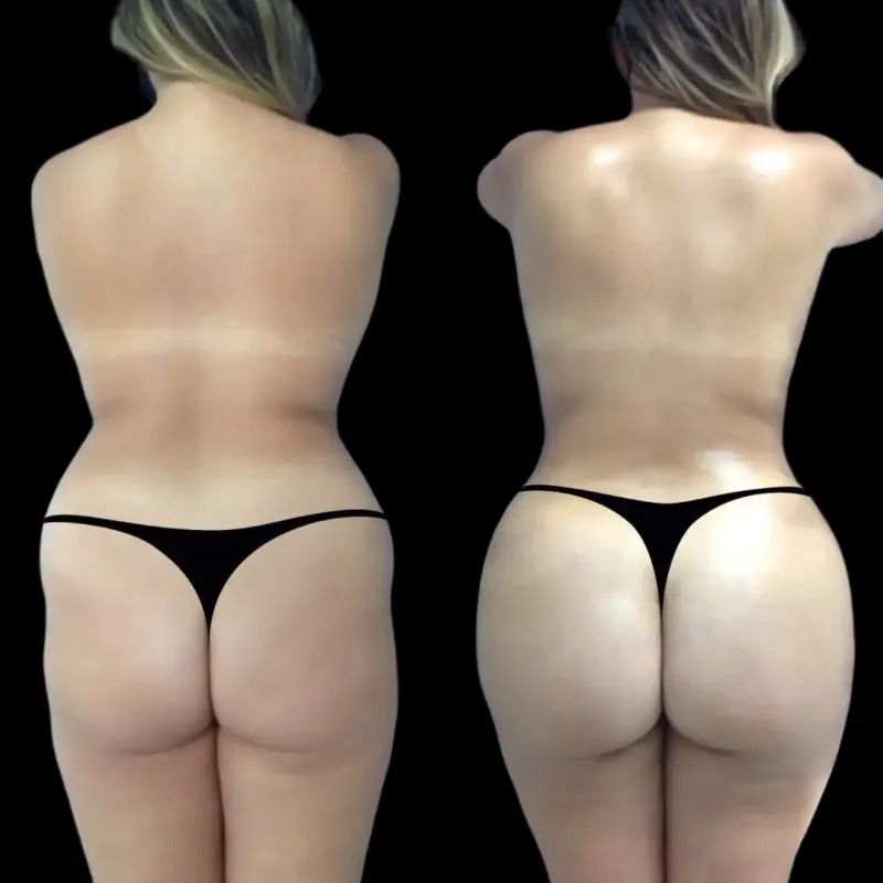 What to Wear After Buttock Augmentation for Optimal Comfort