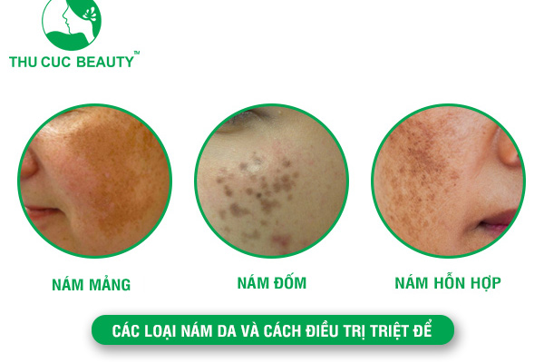 Các loại nám da và cách điều trị và hiệu quả