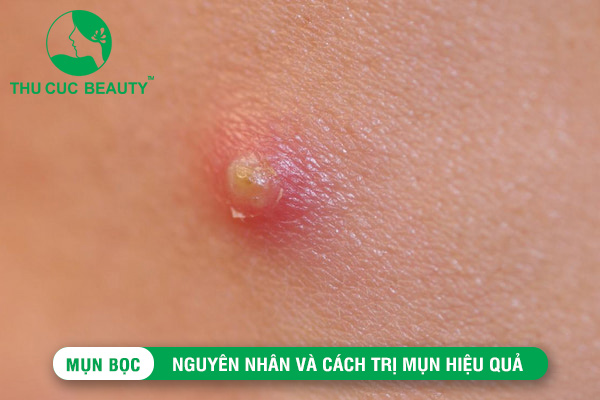 Mụn bọc: Nguyên nhân và cách trị mụn hiệu quả