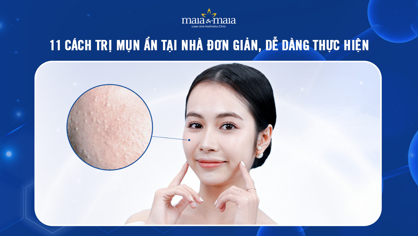 11 cách trị mụn ẩn tại nhà đơn giản, dễ dàng thực hiện - Phòng khám Chuyên khoa Da liễu Maia&Maia