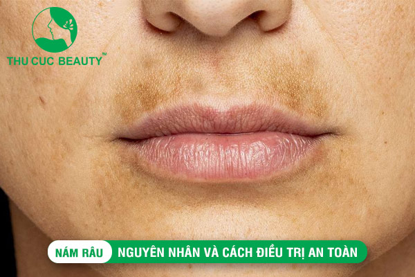 Nám râu: Nguyên nhân và cách điều trị , hiệu quả