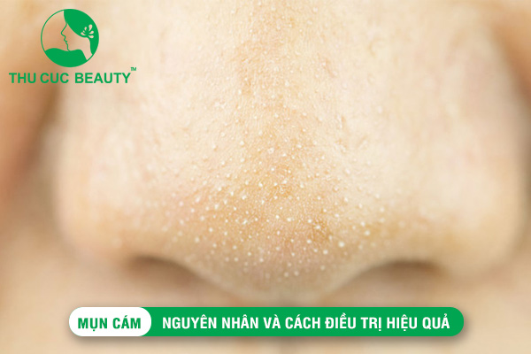 Mụn cám: Nguyên nhân và cách điều trị hiệu quả