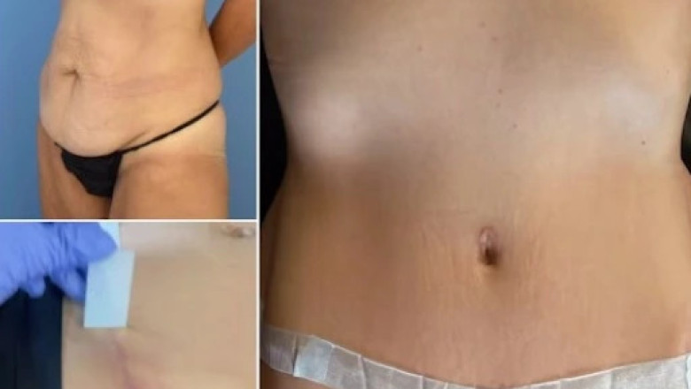 Social Media's Impact on Belly Tuck Trends: The Power of Influence | Times Square Reporter