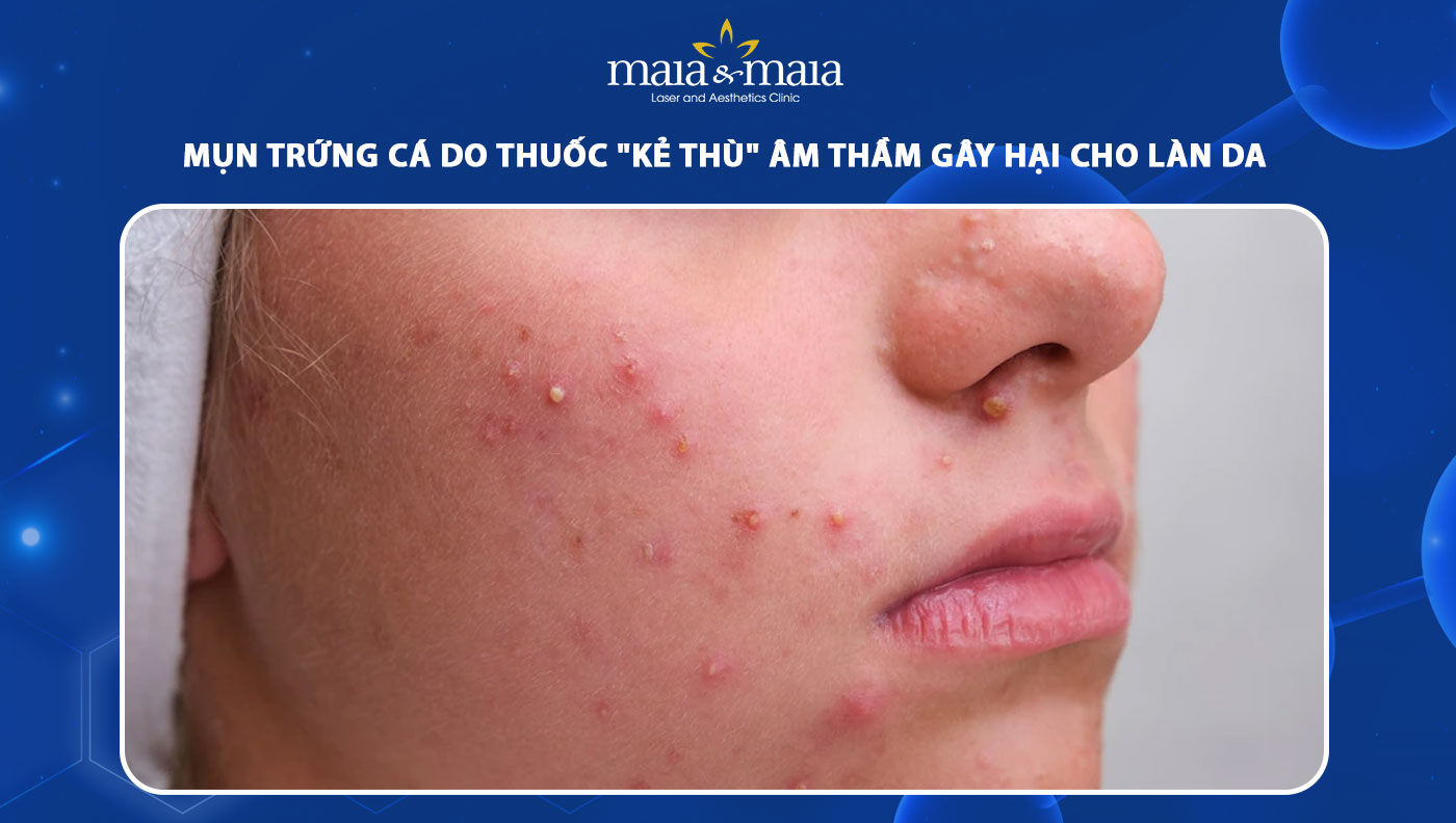 Mụn trứng cá do thuốc "kẻ thù" âm thầm gây hại cho làn da