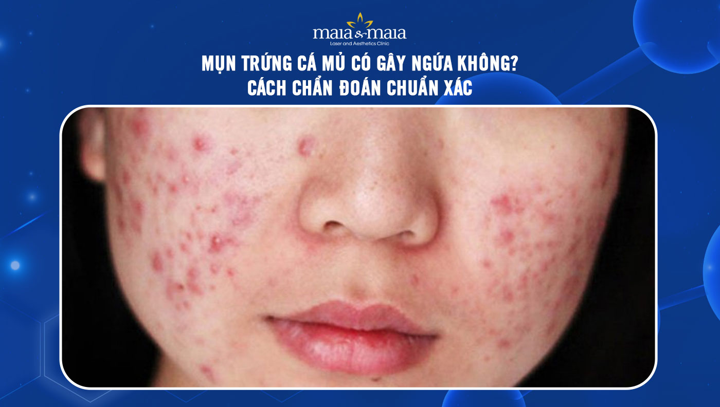 Mụn trứng cá mủ có gây ngứa không? Cách chẩn đoán chuẩn xác