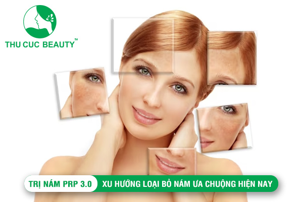 Trị nám PRP 3.0: Xu hướng loại bỏ nám ưa chuộng hiện nay