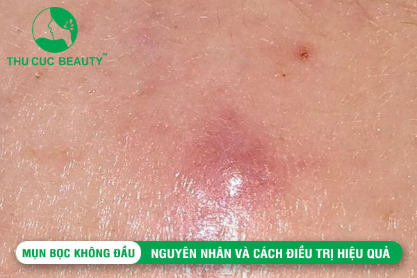 Mụn bọc không đầu: Nguyên nhân và cách điều trị hiệu quả