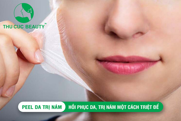 Peel da trị nám: Hồi phục da, trị nám một cách triệt để