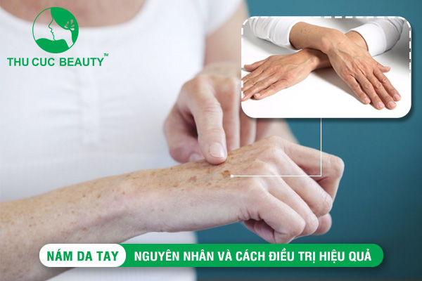 Nám da tay: Nguyên nhân và cách điều trị hiệu quả