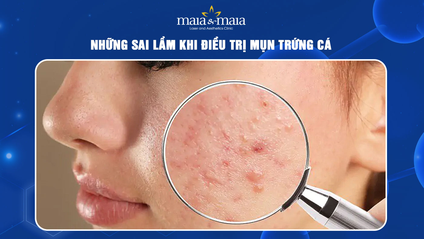 Những Sai Lầm Khi Điều Trị Mụn Trứng Cá