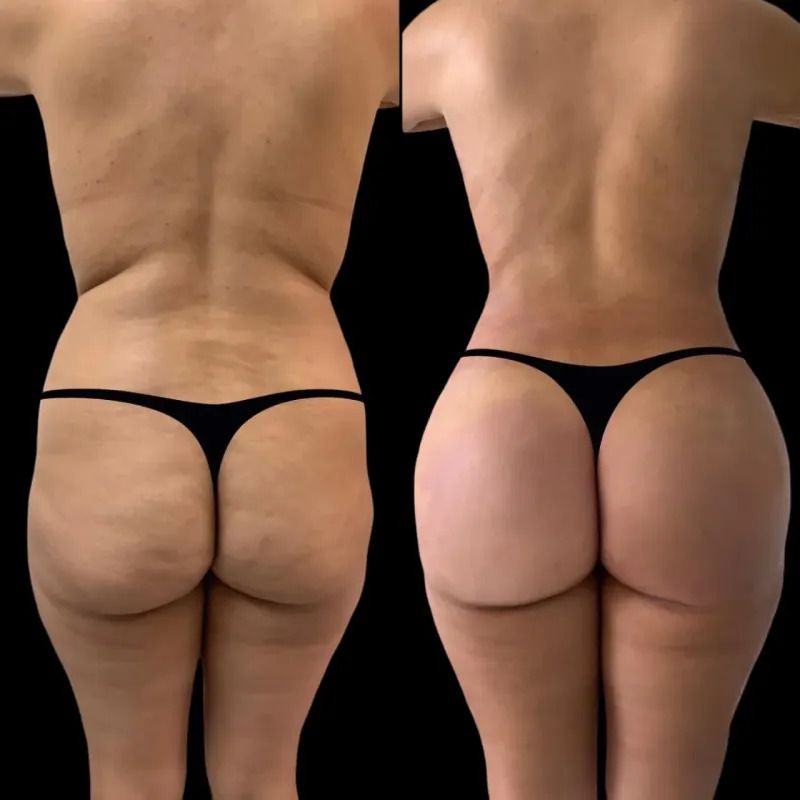 How Long Does It Take to Recover From a Buttock Lift?