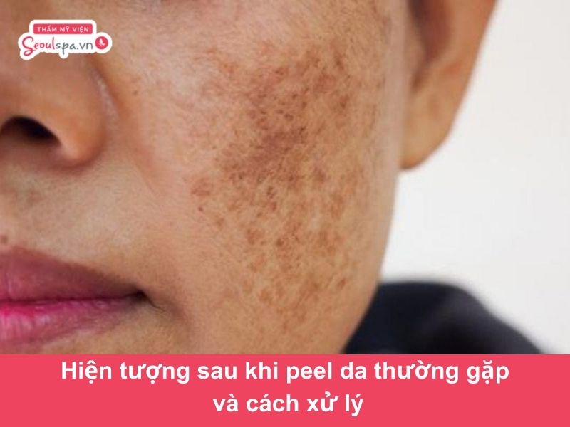 Hiện tượng sau khi peel da thường gặp và cách khắc phục