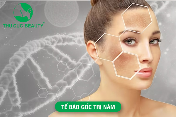 Tế bào gốc trị nám và những phương pháp điều trị phổ biến