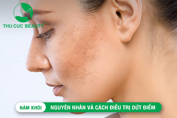 Nám khói: Nguyên nhân và cách điều trị dứt điểm