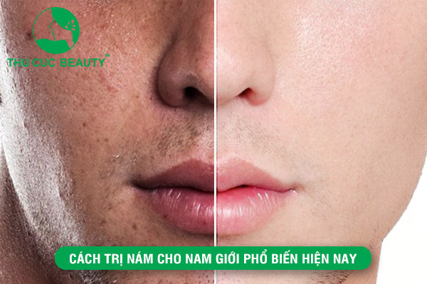 Cách trị nám cho nam giới phổ biến hiện nay