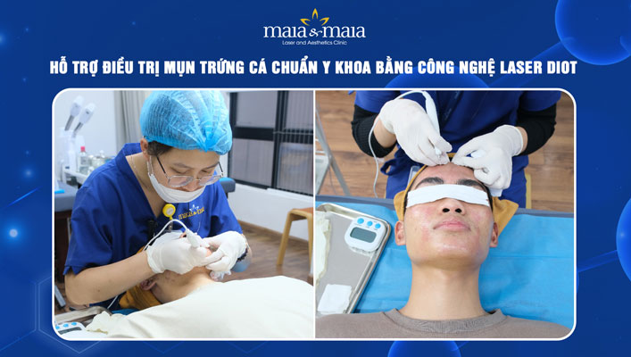 Phác đồ điều trị mụn trứng cá bằng công nghệ Laser Diot