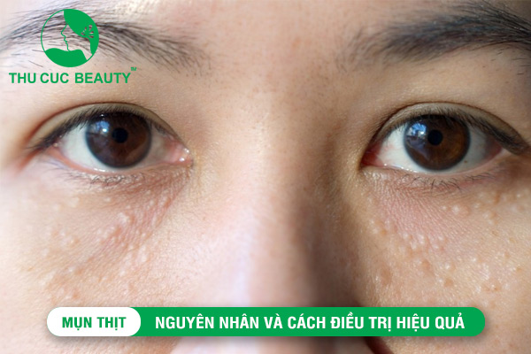 Mụn thịt: Nguyên nhân và cách điều trị hiệu quả