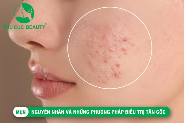 Mụn: Nguyên nhân và những phương pháp điều trị tận gốc