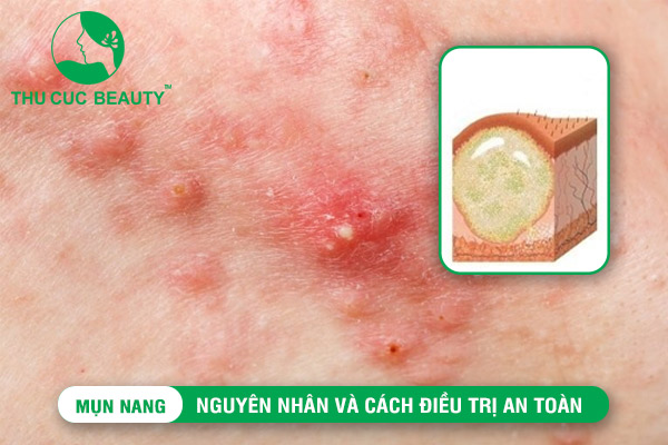 Mụn nang: Nguyên nhân và cách điều trị