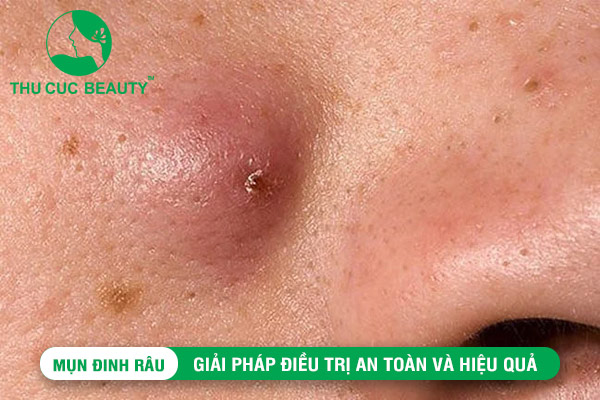 Mụn đinh râu: Giải pháp điều trị và hiệu quả