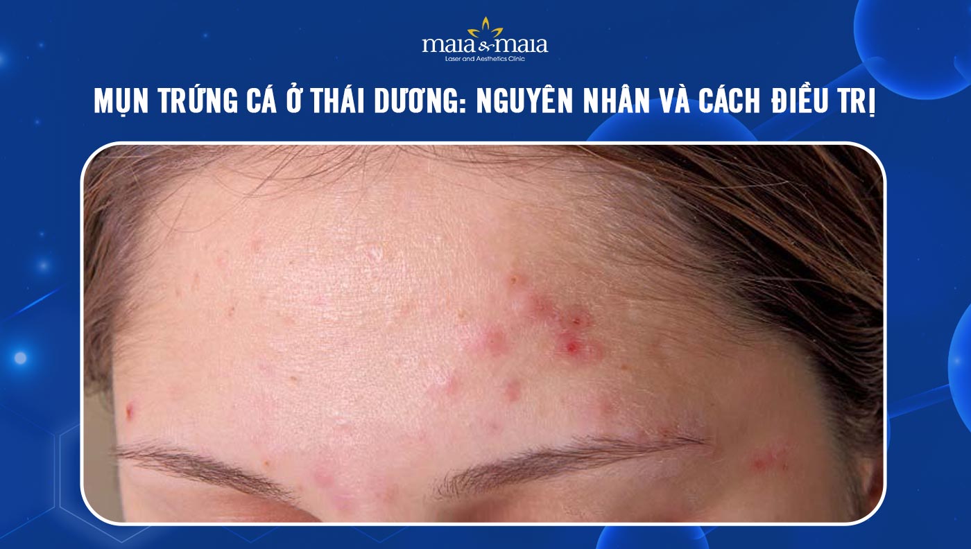 Mụn trứng cá ở thái dương: Nguyên nhân và cách điều trị