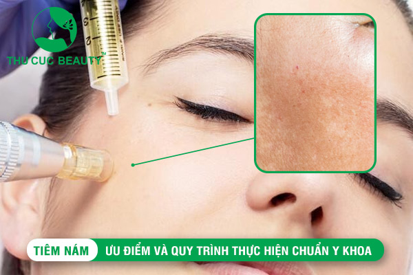 Tiêm nám: Ưu điểm và quy trình thực hiện chuẩn y khoa