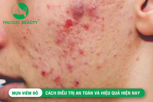 Mụn viêm đỏ: Cách điều trị và hiệu quả