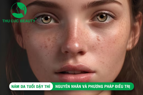 Nám da tuổi dậy thì: Nguyên nhân và phương pháp điều trị