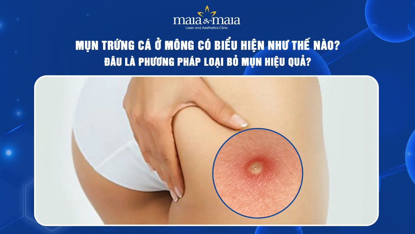 Mụn trứng cá ở mông: Biểu hiện và cách điều trị hiệu quả