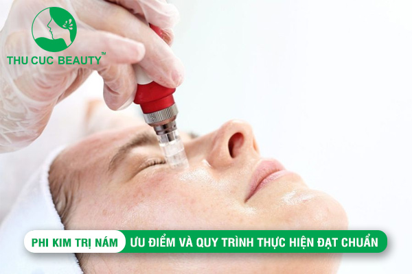 Phi kim trị nám: Ưu điểm và quy trình thực hiện đạt chuẩn