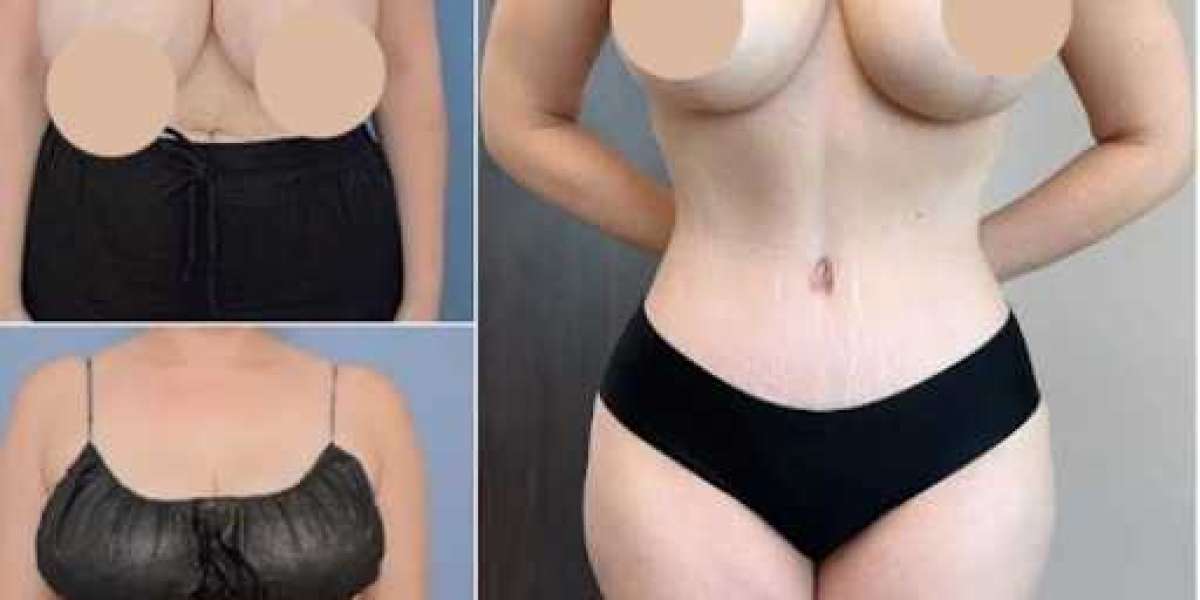 How to Achieve the Best Results from Your Tummy Tuck in Dubai