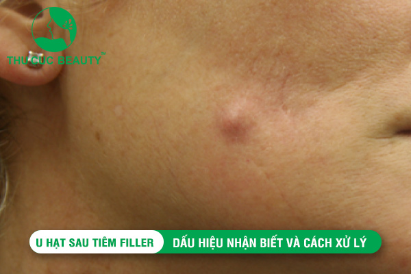 U hạt sau tiêm filler: Dấu hiệu nhận biết và cách xử lý