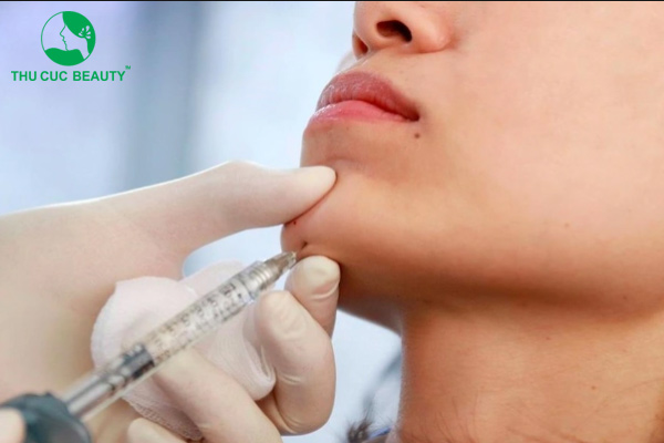 Hướng dẫn kỹ thuật tiêm filler an toàn và hiệu quả