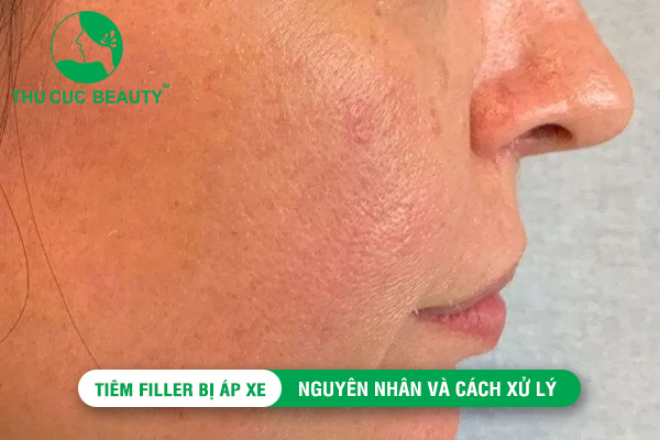 Tiêm filler bị áp xe: Nguyên nhân và cách xử lý