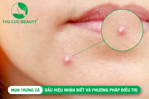 Mụn trứng cá: Dấu hiệu nhận biết và phương pháp điều trị