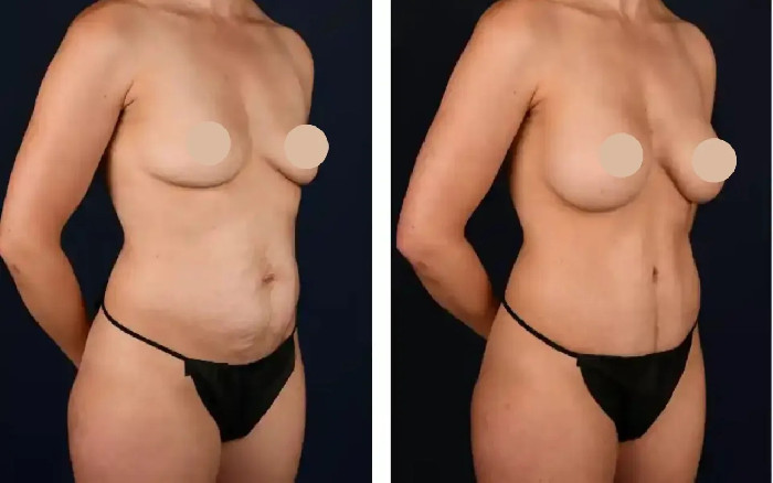 Cost of Tummy Tuck in Dubai: What to Expect :: Plastic Surgery clinic dubai