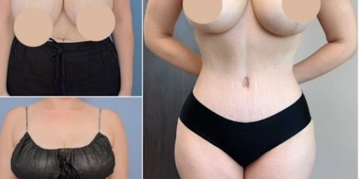 Mini Tummy Tuck vs. Full Tummy Tuck in Dubai