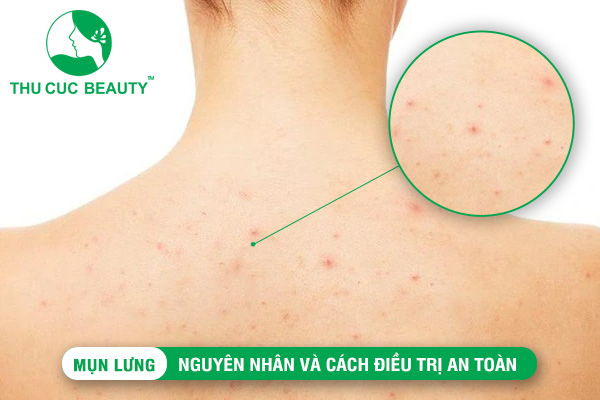 Mụn lưng: Nguyên nhân và cách điều trị