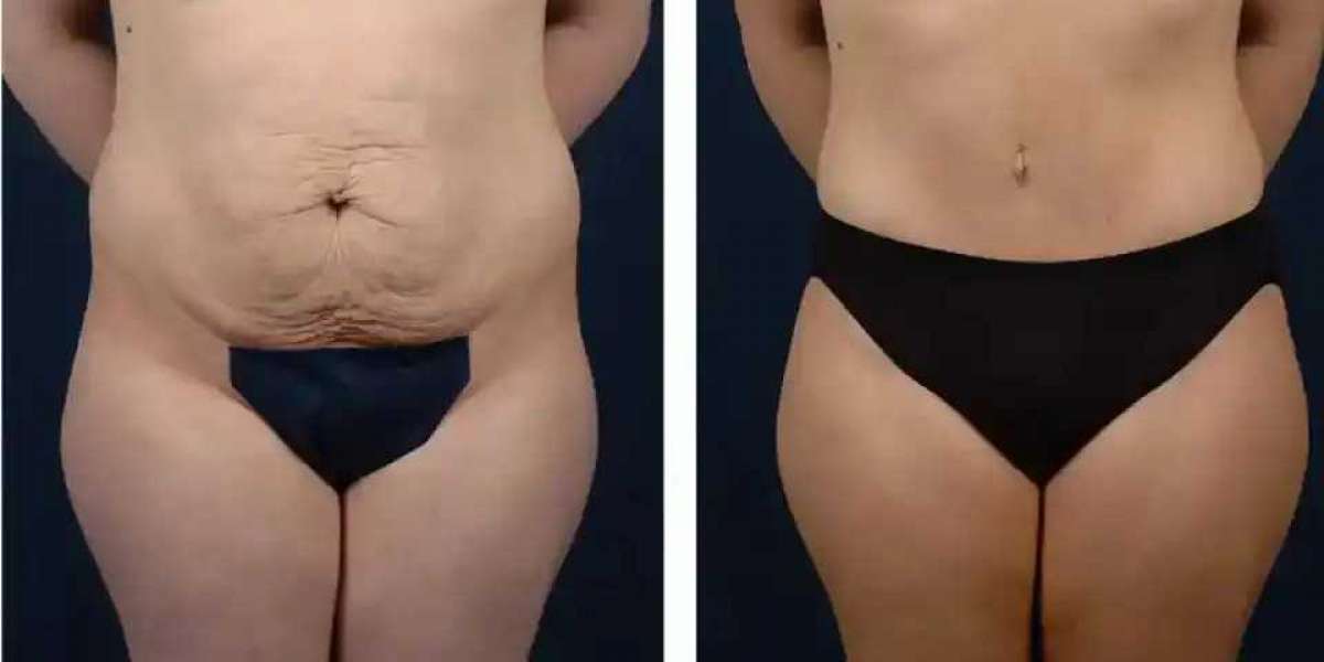 Tummy Tuck in Dubai: How to Ensure the Best Possible Outcome