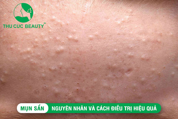 Mụn sẩn: Nguyên nhân và cách điều trị hiệu quả