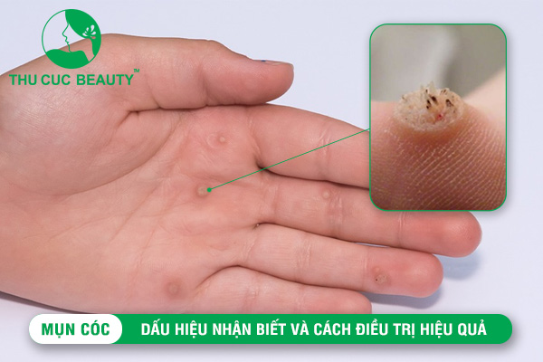 Mụn cóc: Dấu hiệu nhận biết và cách điều trị hiệu quả